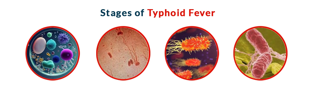 Stages of Typhoid Fever
